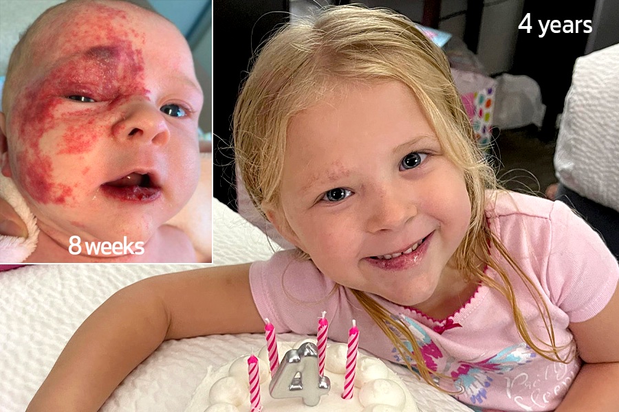 Piper Cramer at 8 weeks and 4 years, showing loss of much hemangioma. 