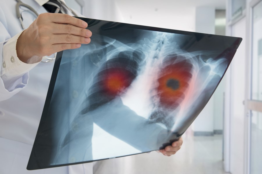 Image of doctor in white coat holding up a scanned image of a chest and lungs. There are red circles on each side of the chest, as well as a black spot that marks a tumor in the lungs.