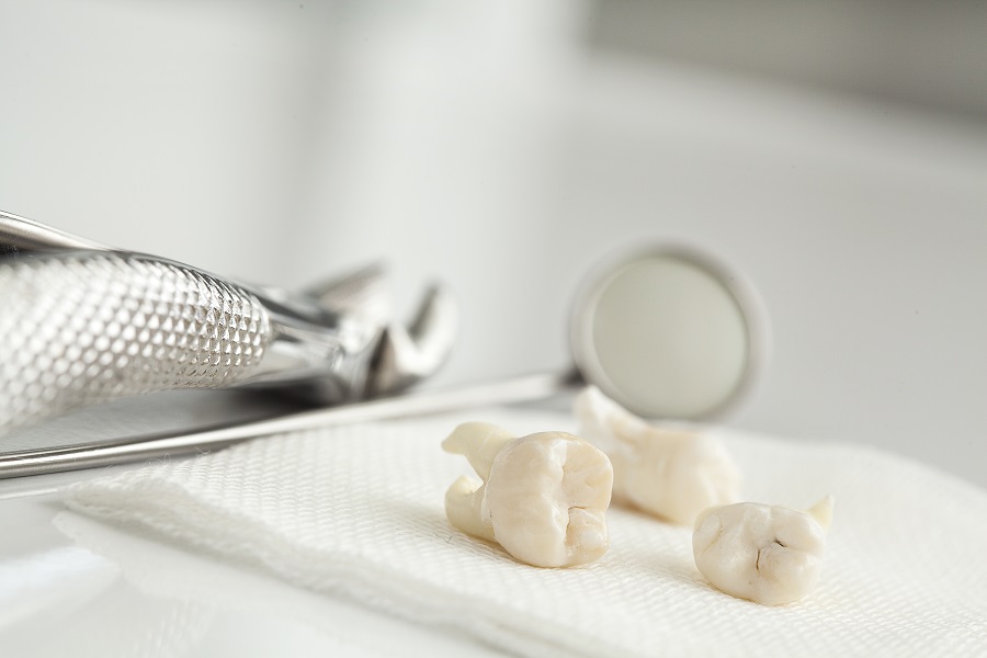 An image of three removed, intact molar teeth on a piece of white gauze. A chrome mirror tool and other dental tools are in the background.