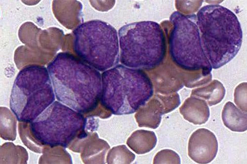 A microscope slide shows leukemic white blood cells, stained purplish, surrounded by nondescript red cells. 
